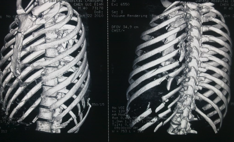 肋骨骨折及其治疗原则 肋骨骨折 肋骨骨折及其治疗原则 肋骨骨折