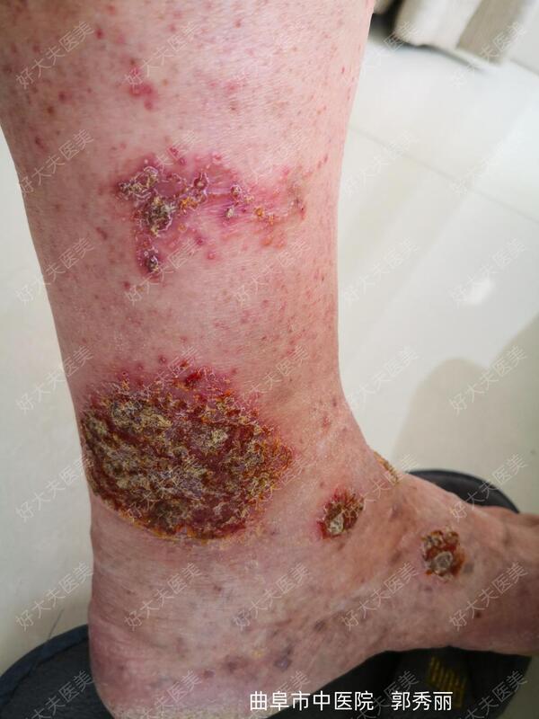 湿疹后期鳞屑结痂图片图片