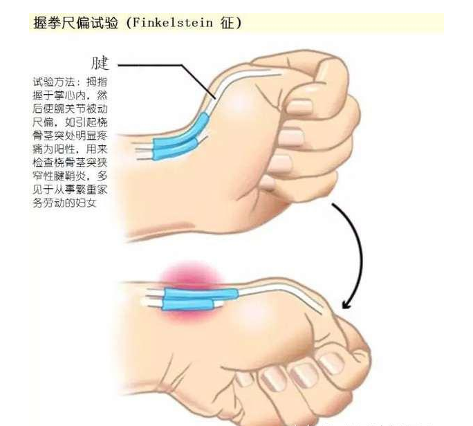 常見的肌腱炎有:橈骨莖突狹窄性腱鞘炎,屈指肌腱狹窄性腱鞘炎,肌鞘炎