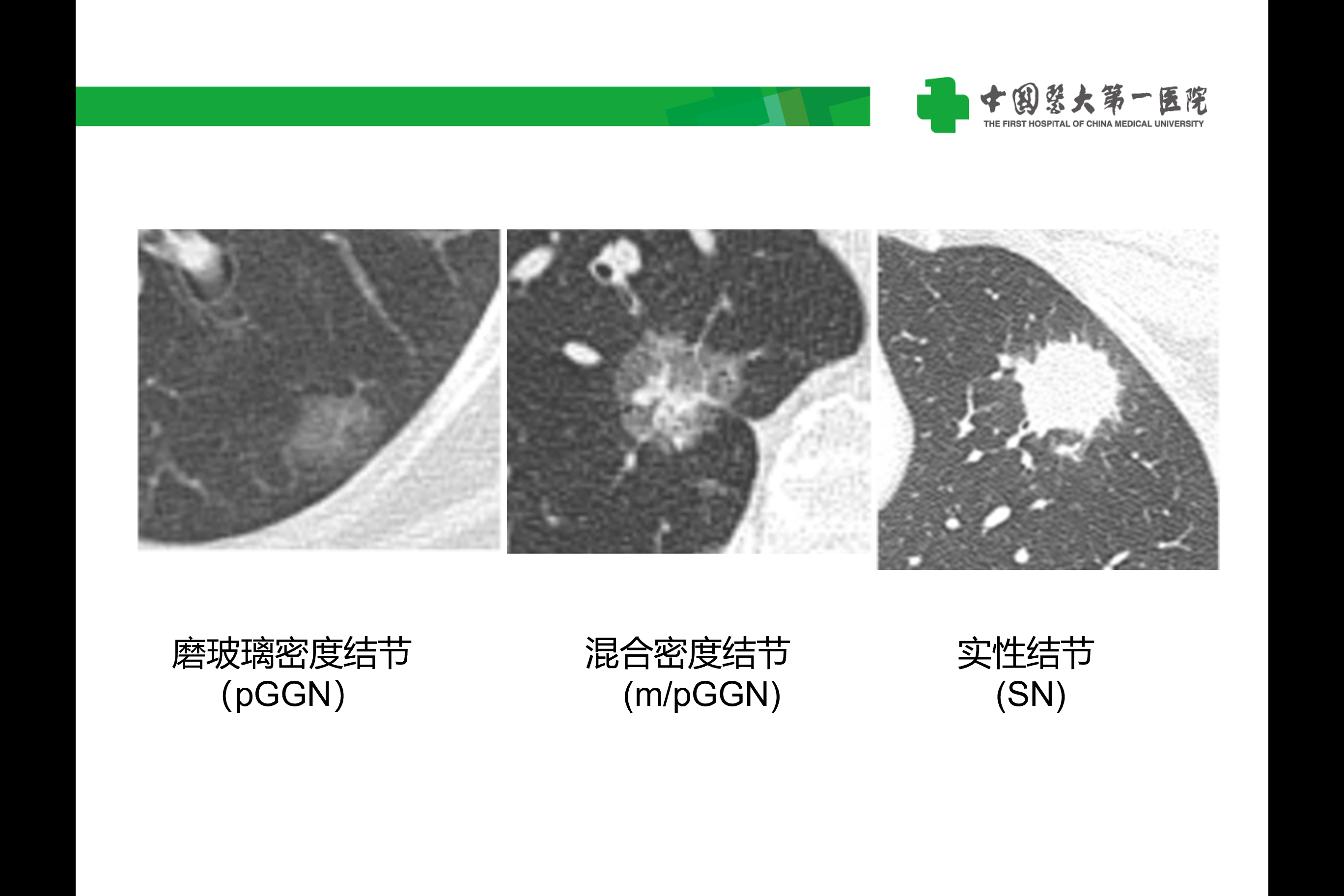 早期肺癌磨玻璃結節的典型圖片