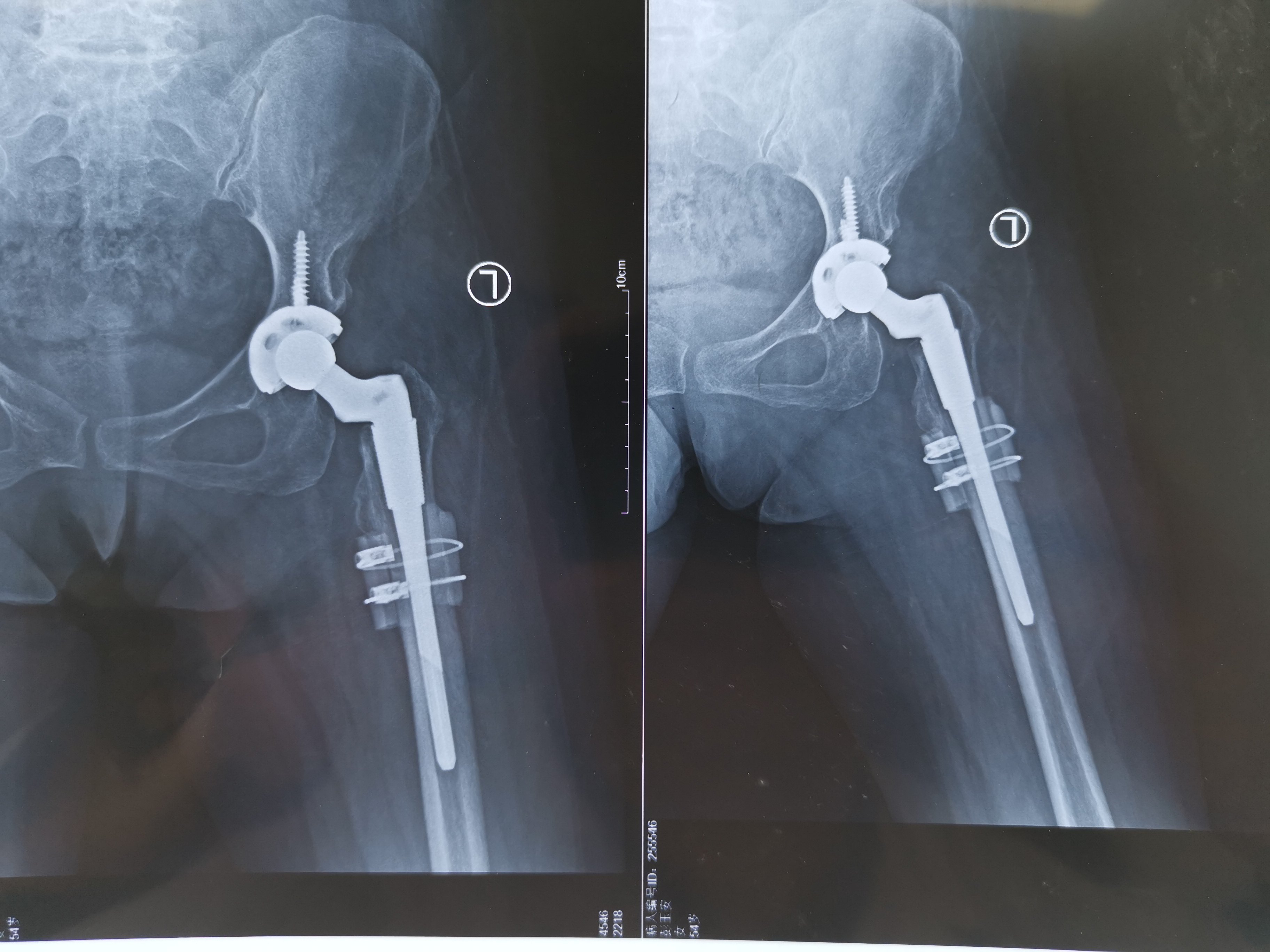 假体位置良好,肢体长度恢复择期行左髋关节置换术术前左侧髋关节脱位
