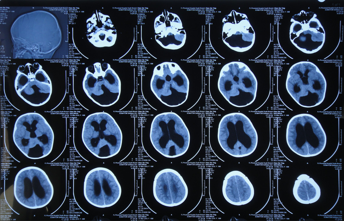 查头ct:后颅窝蛛网膜囊肿,重度脑积水(交通性),双侧小脑蚓部未见,考虑