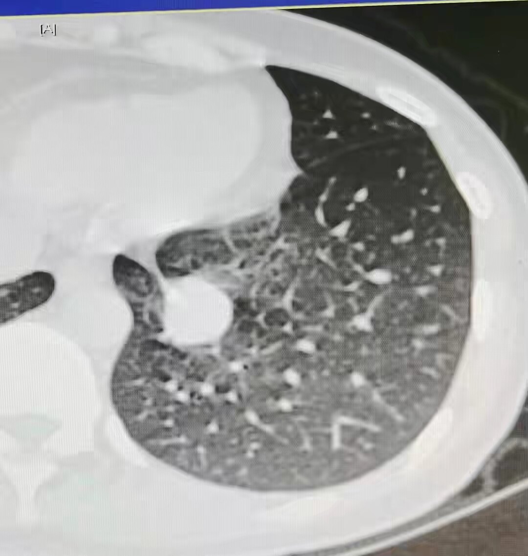 肺癌唾液白色泡沫图片图片
