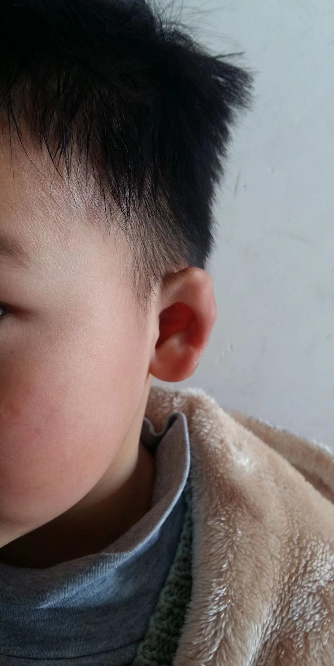 小耳畸形舒展修复手术后耳朵可以长大! - 好大夫在线