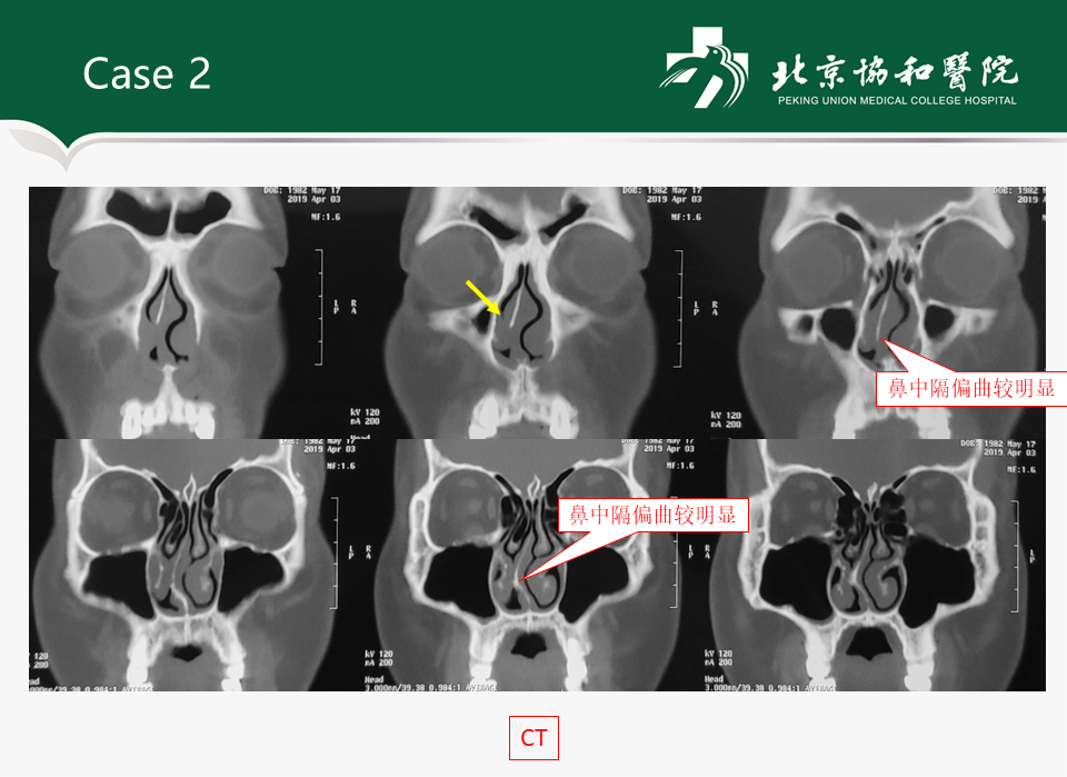 鼻中隔矯正術後或下鼻甲術後鼻腔粘連的處理