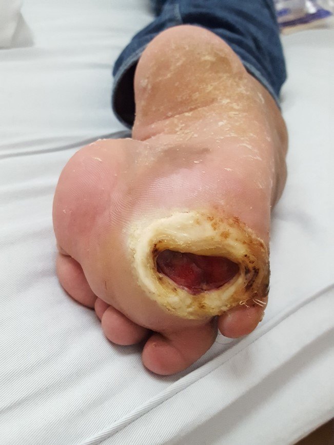 先天性马蹄内翻足_介绍_症状表现_治疗方式 - 好大夫在线