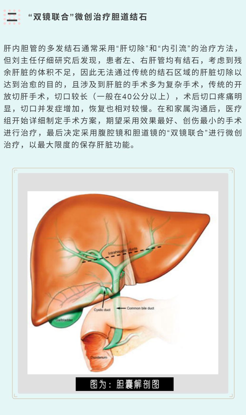 案例分享肝內膽管結石頻發巧用雙鏡聯合微創治療