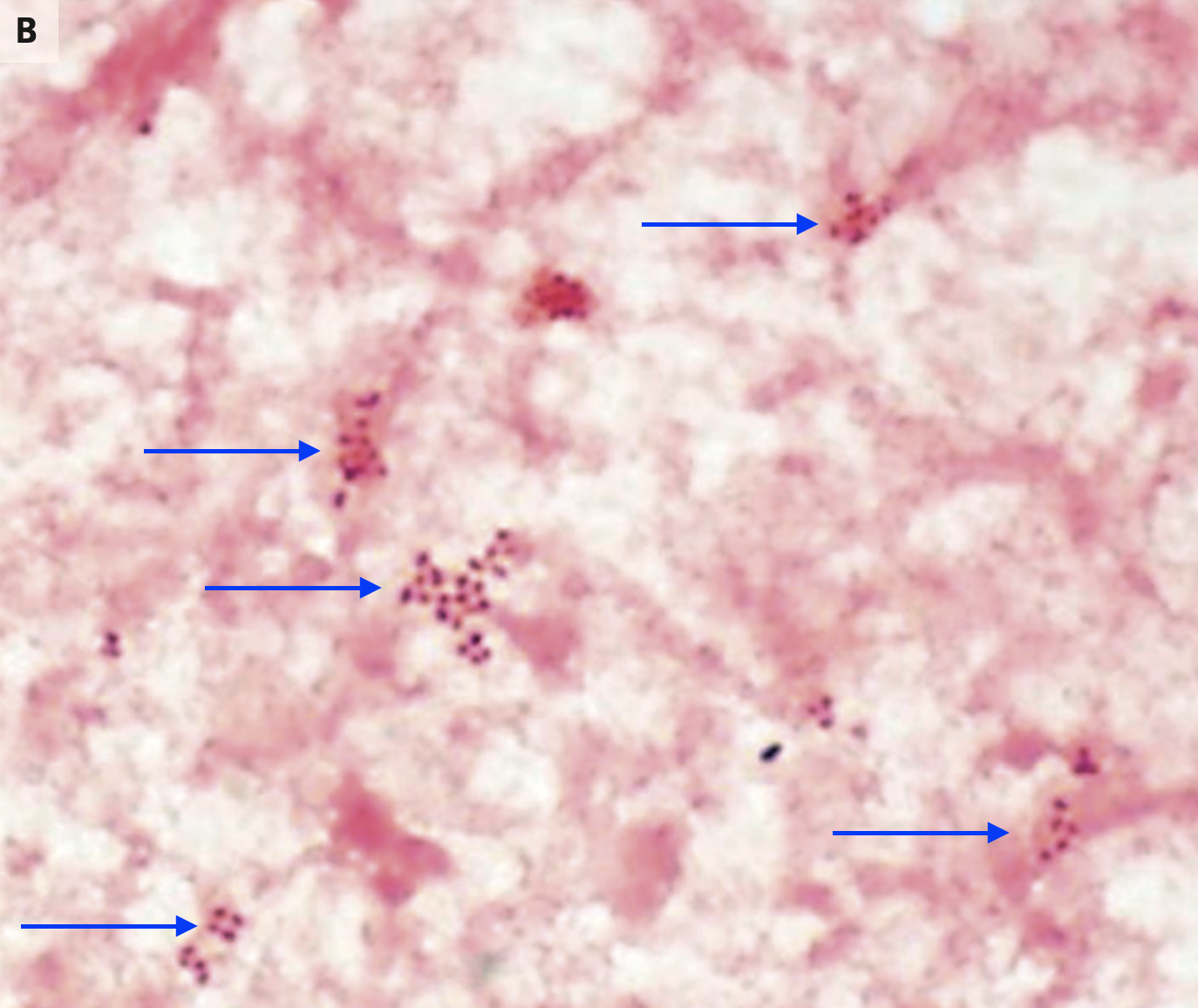 播散性淋病/散播性淋球菌感染 1——病例1【图片可能引起不适,请谨慎