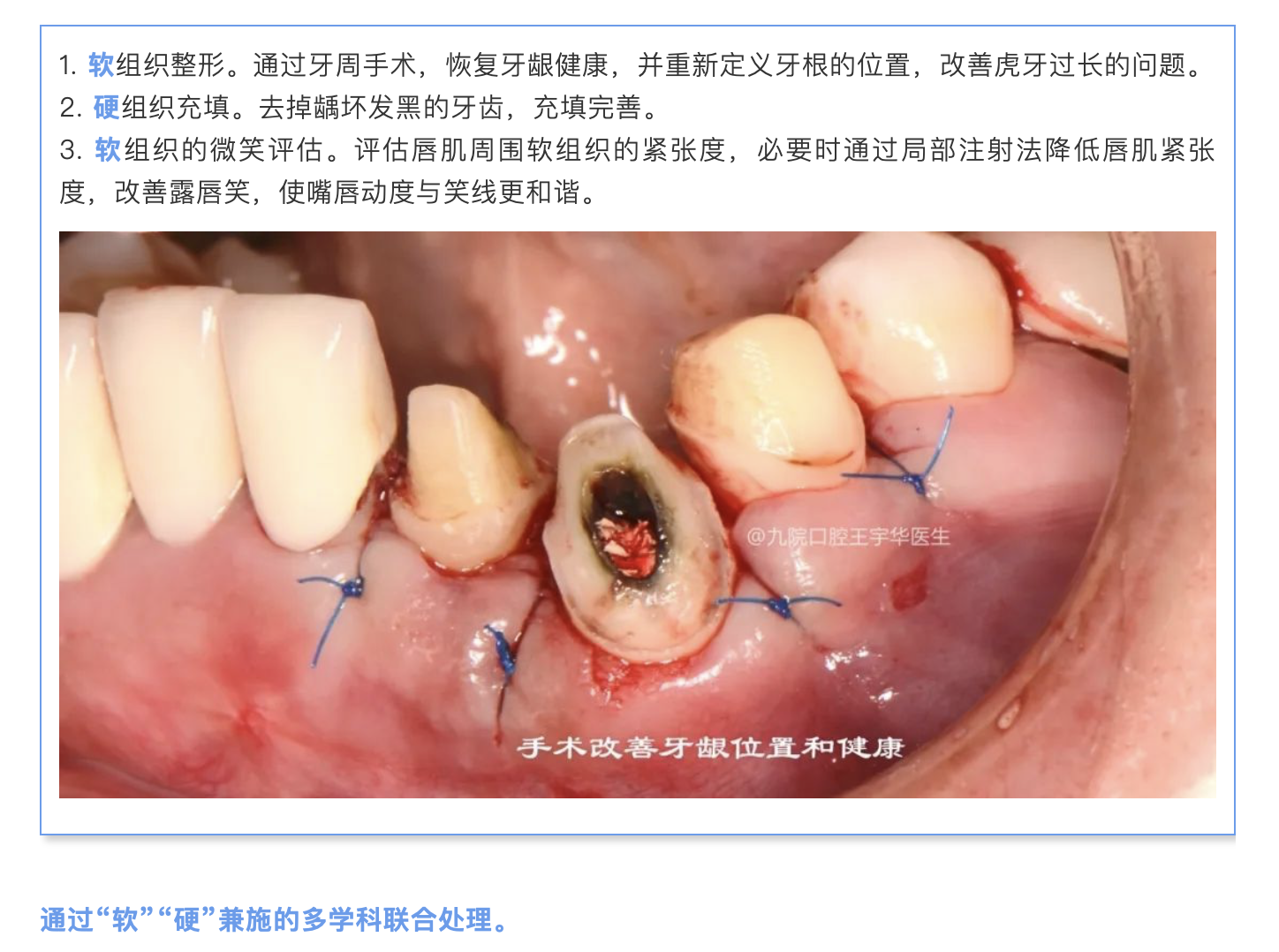 不整齐的鲍牙小虎牙,需要怎么处理