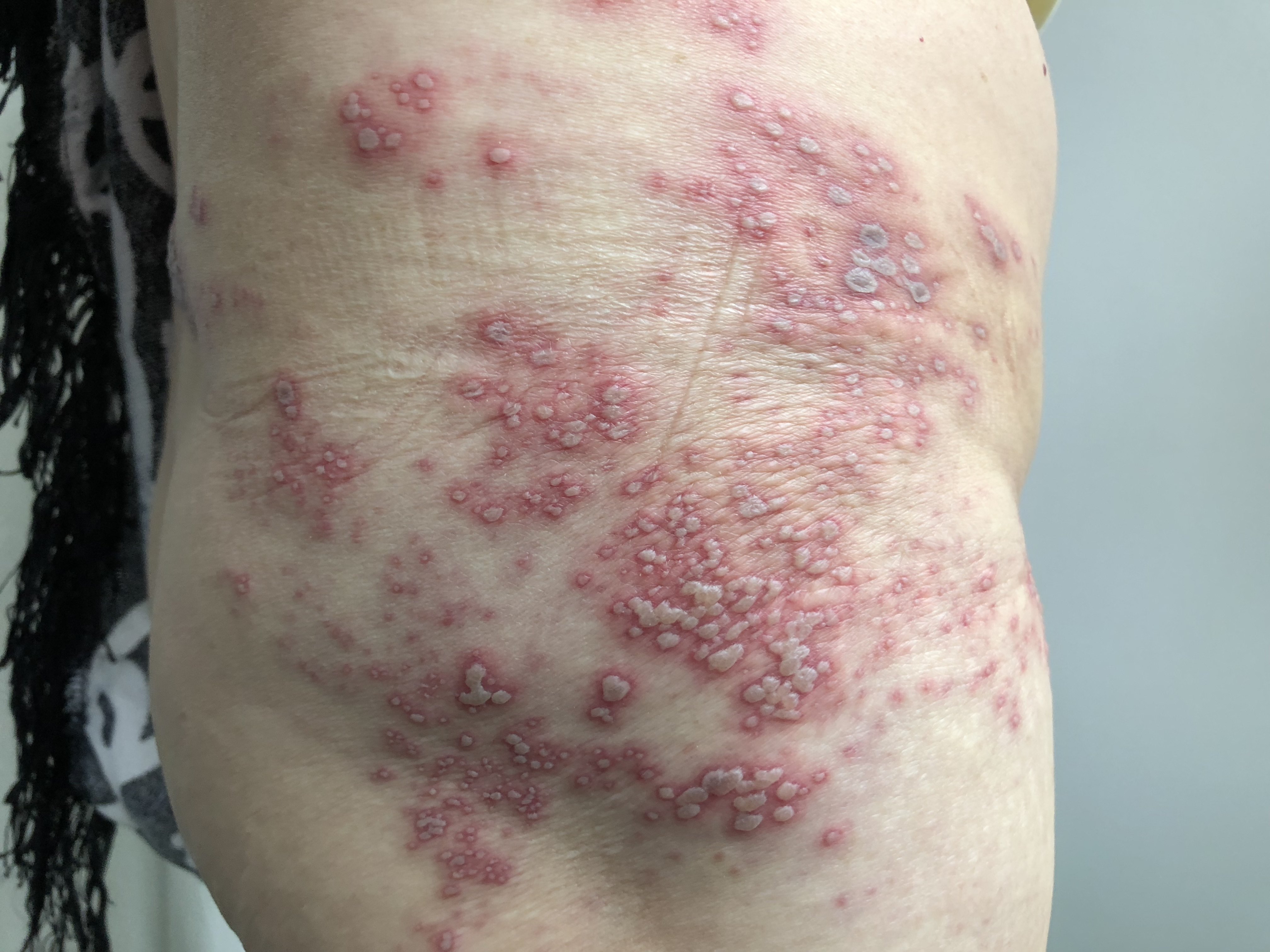 治疗蛇盘疮最快的方法_蛇盘疮最佳治疗方法是什么_白巫术治疗蛇盘疮