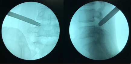 (   )侧隐窝阻滞治疗
