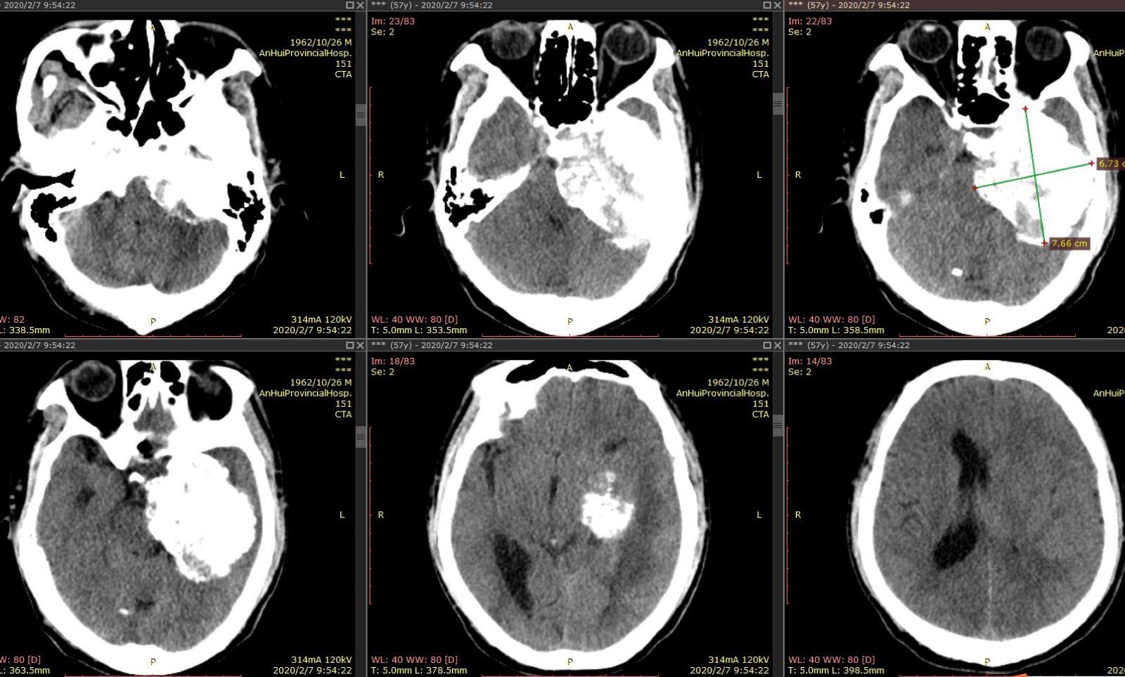 疫情下的巨大岩斜坡脑膜瘤-3.jpg