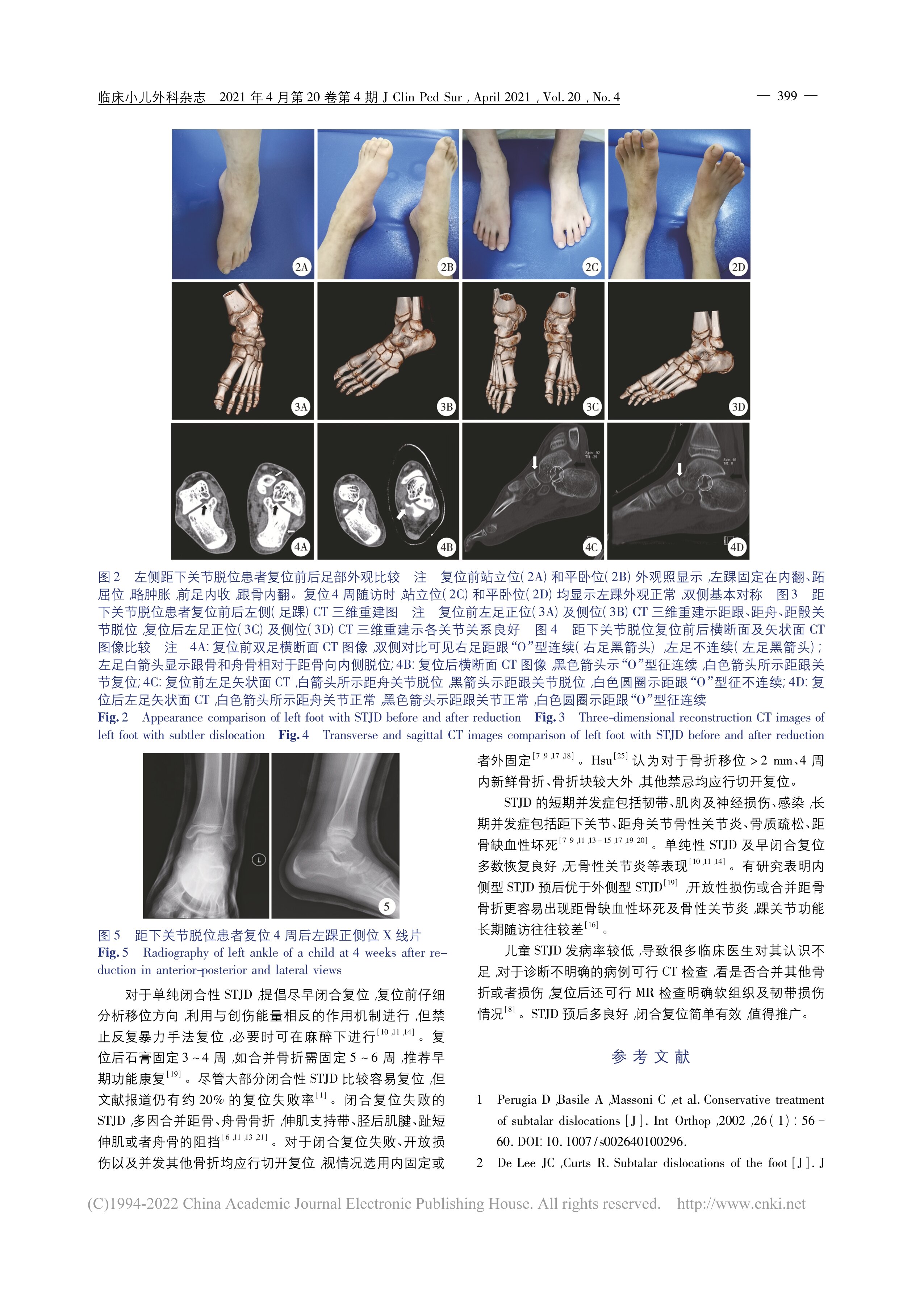 闭合复位治疗儿童距下关节脱位