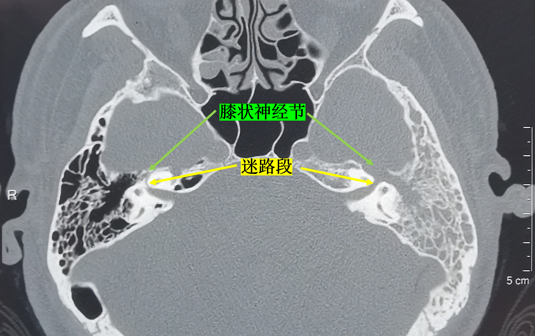 病例4:ct示病变累及面神经膝状神经节,鼓室段,乳突段,向内达颞骨岩部.