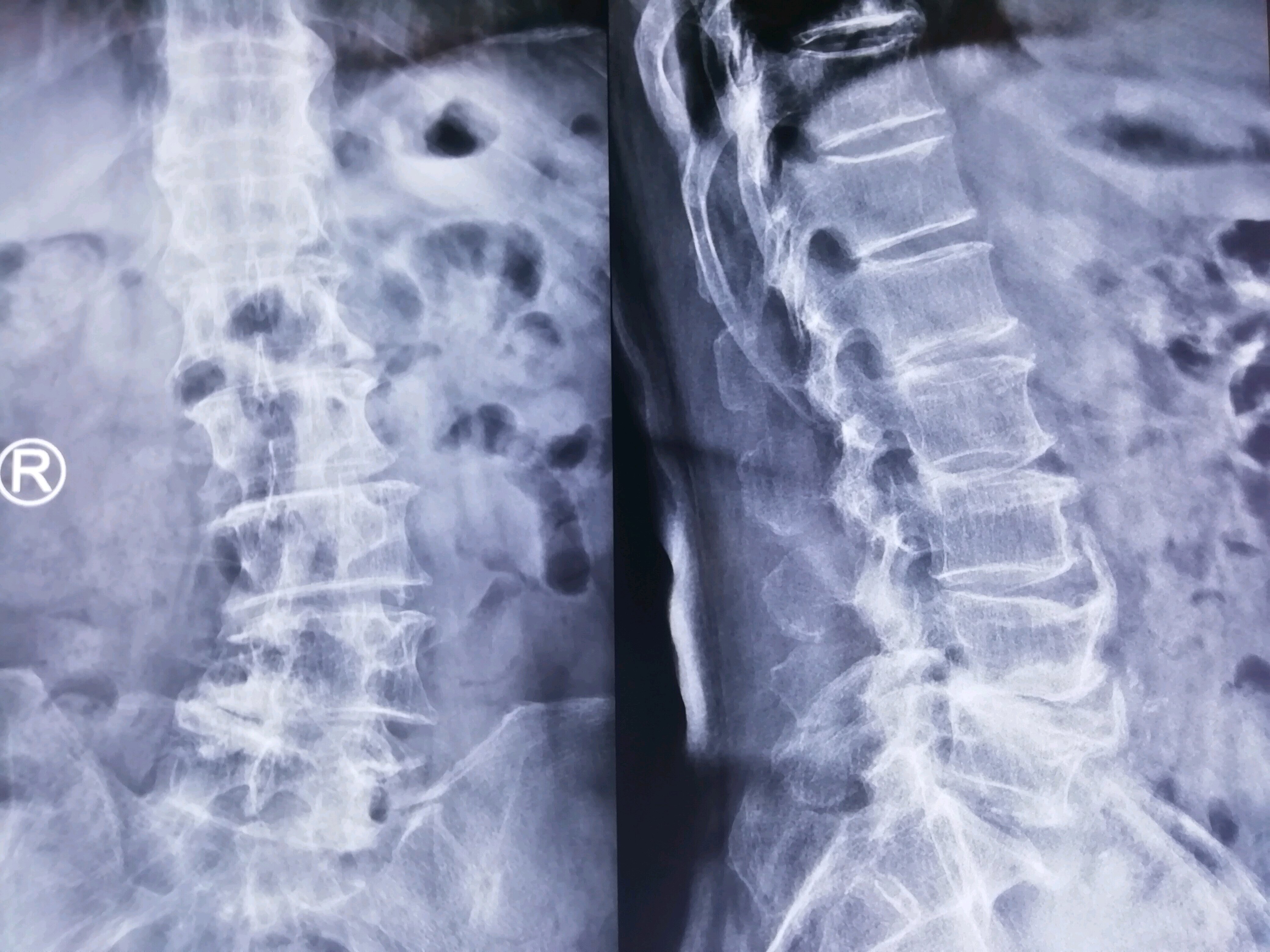midlf手术治疗腰椎管狭窄症伴有腰椎退变性侧弯畸形