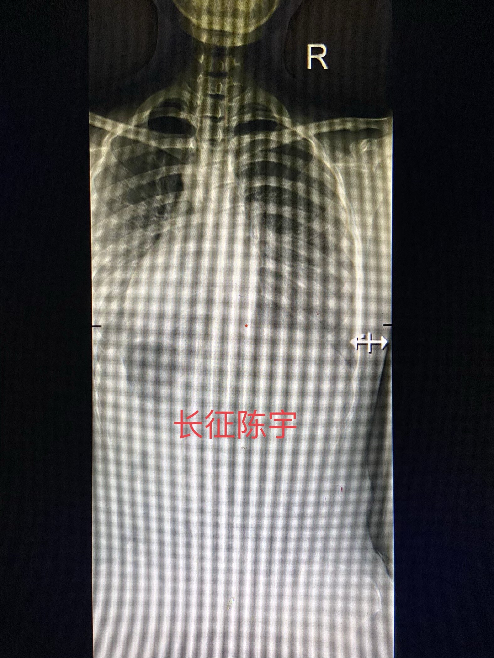 脊柱侧弯80度外观图片图片