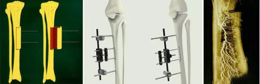 截断一小块胫骨骨块,安装外固定架