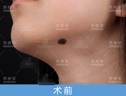 痣 - 好大夫在线