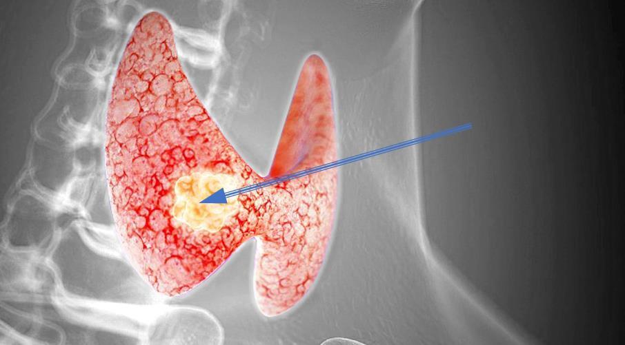 甲状腺癌为何可以选择微创消融治疗?