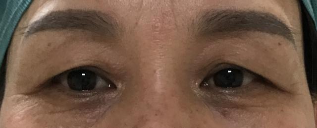 提眉手术与切眉手术的区别_提眉术 - 好大夫在线