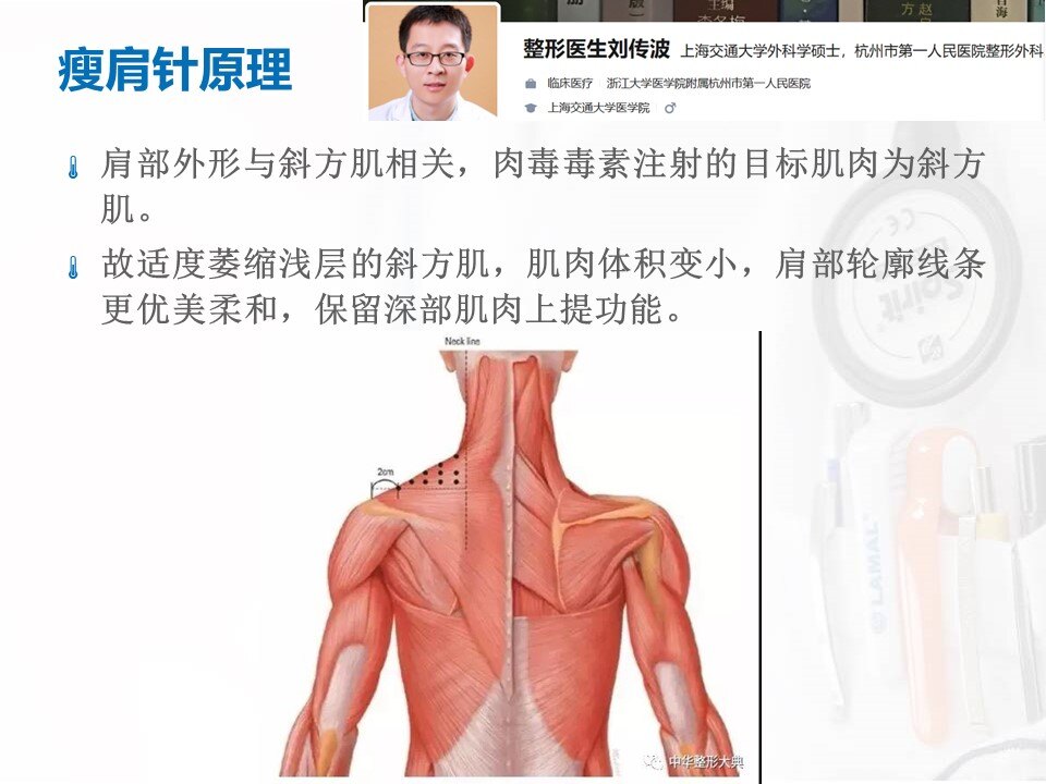 瘦肩针的注射部位图解图片