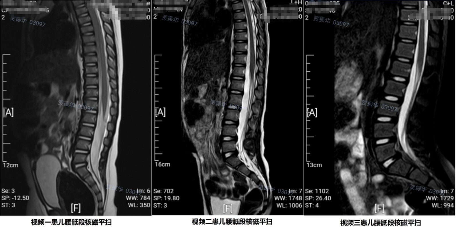 小儿脊髓栓系后背图片