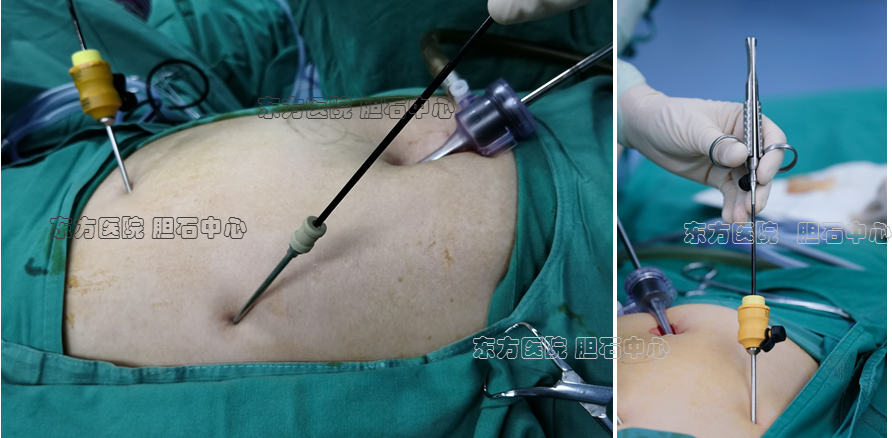 胡氏切口 ——东方胆石中心超微创腹腔镜手术的必修课 
