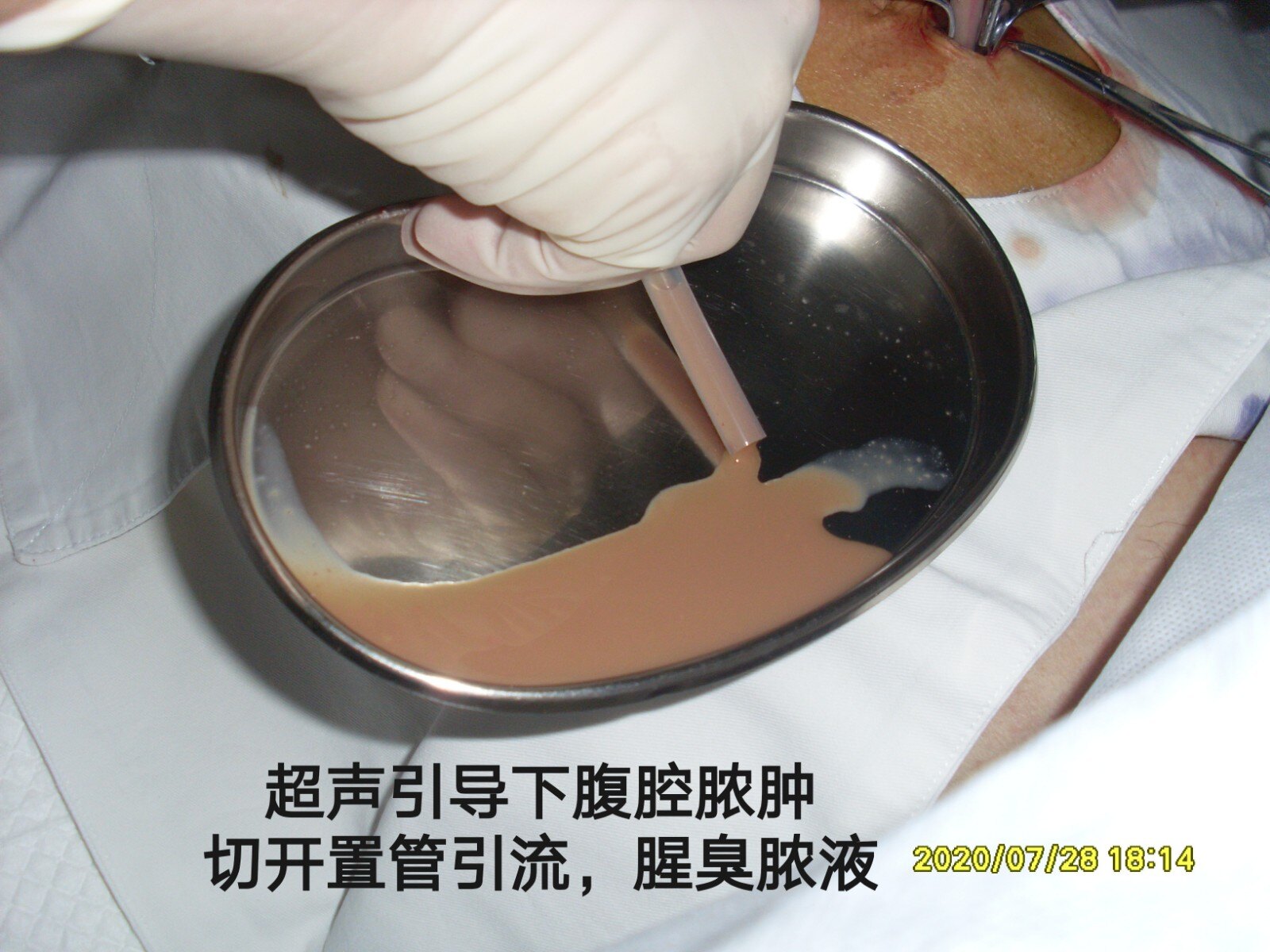 引出1000ml,脓液淀粉酶正常,考虑外源性逆行感染或者肠内瘘感染形成腹