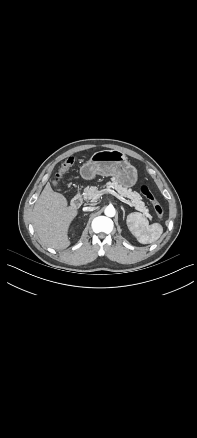 处为左肾肿瘤1红圈标示处为左肾肿瘤2基于外院ct数据的三维重建图像