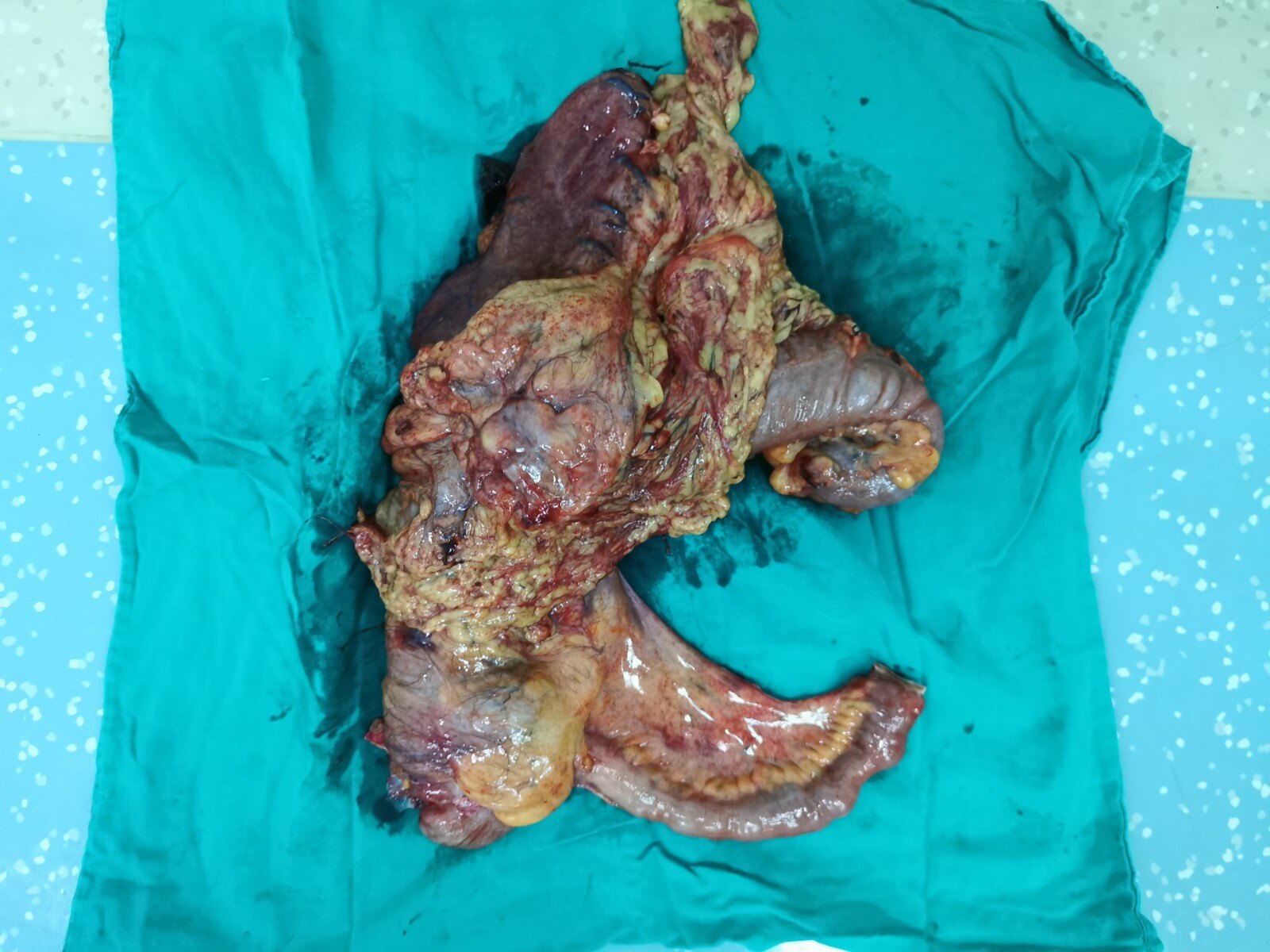 一例特殊的横结肠癌侵犯胃的病人