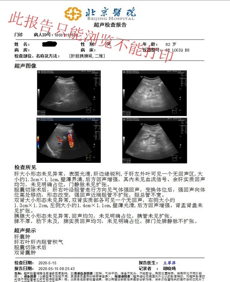 胆囊结石30年诱发胆囊癌,根治手术后5年,无病健康生活,早发现,早治疗