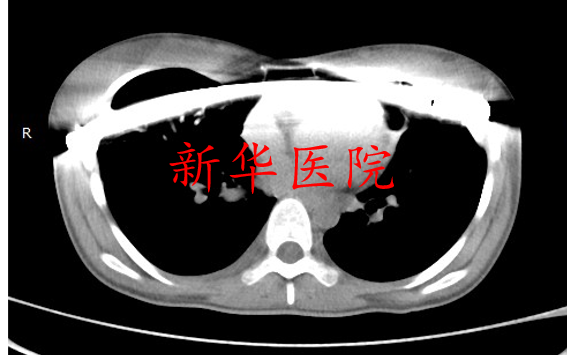 成人漏斗胸微創手術系列4女性重度漏斗胸