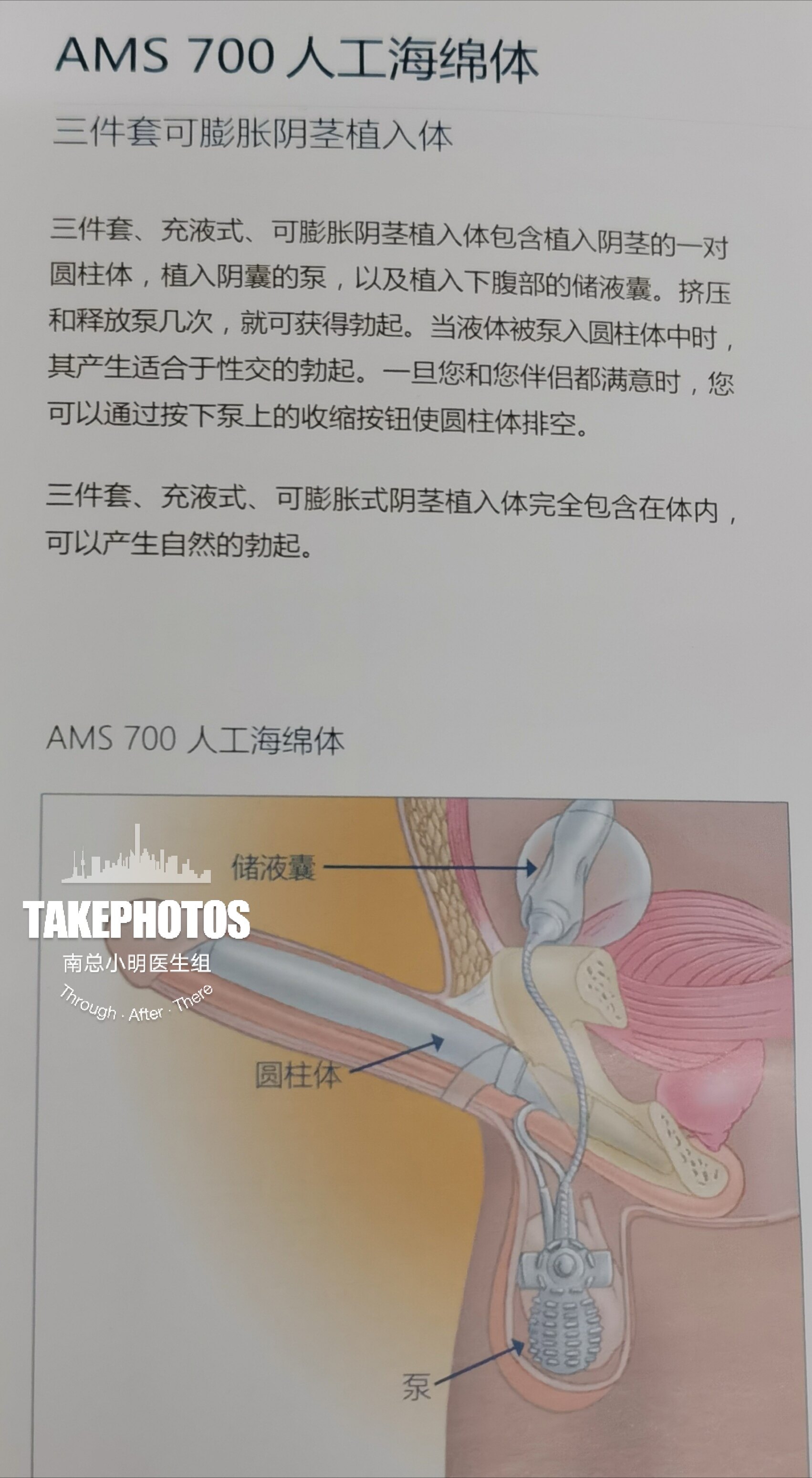 男性健康日男性功能很重要重度勃起功能障礙的剋星人工海綿體