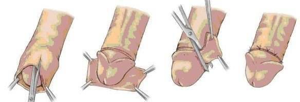 传统包皮环切术【最经典的手术方式】:手术方式最为经典,通过手工的
