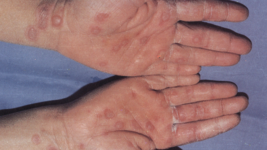 多形红斑型药疹大疱性表皮松解型药疹剥脱性皮炎型药疹广大有过敏素质