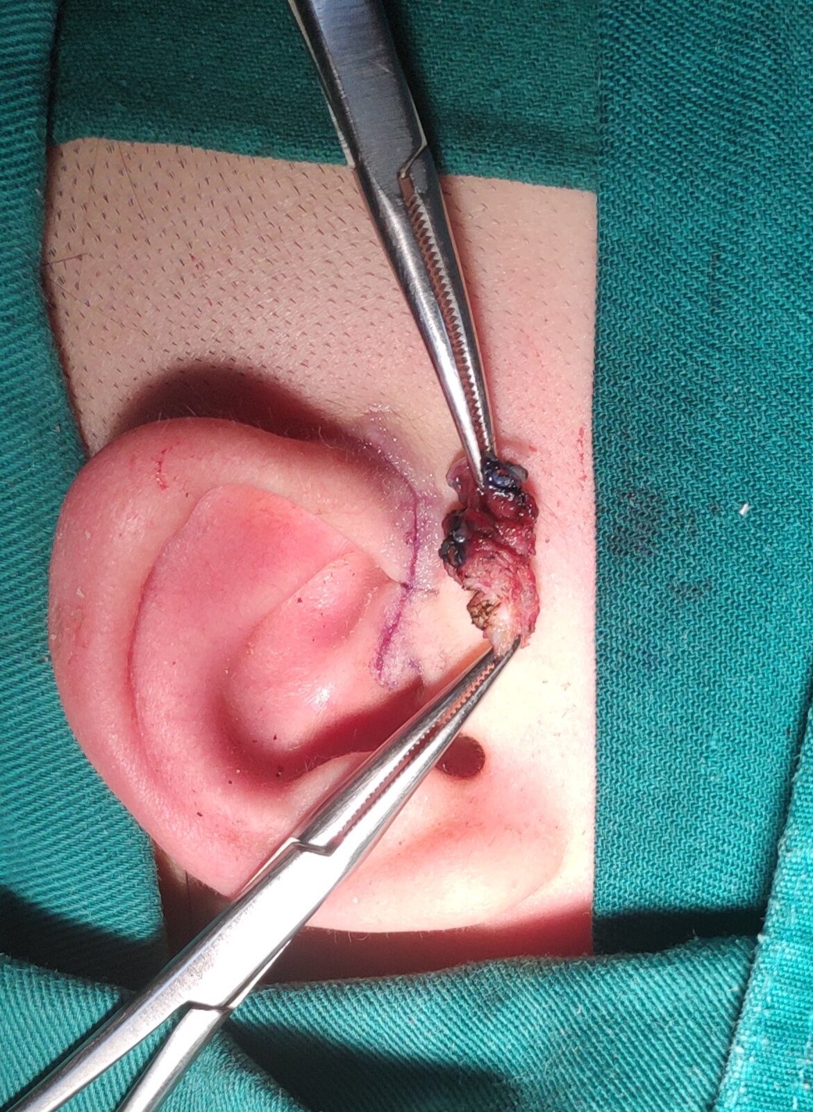 先天性耳前瘘管感染期手术与非感染期手术对比