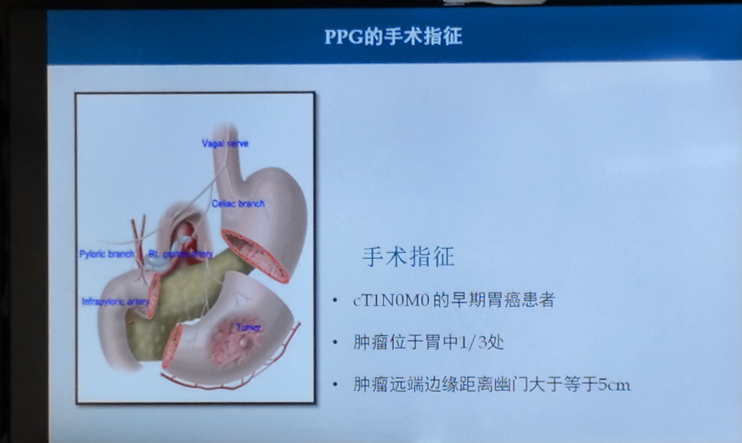 早期胃體癌的保胃腹腔鏡手術治療_胃癌_胃癌治療方式 - 好大夫在線