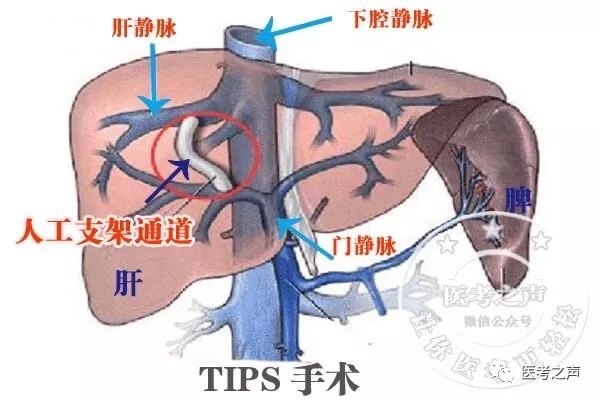 tips手术步骤的图片图片