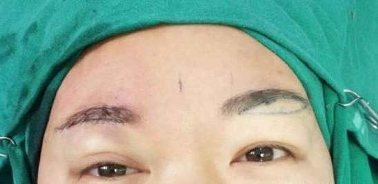 关于 34 提眉术 34 你最担心是 睡觉眼睛闭不上 变吊眼皮 留疤 提眉术 关于 34 提眉术 34 你最担心是 睡觉眼睛闭不上 变吊眼皮 留疤 提眉术