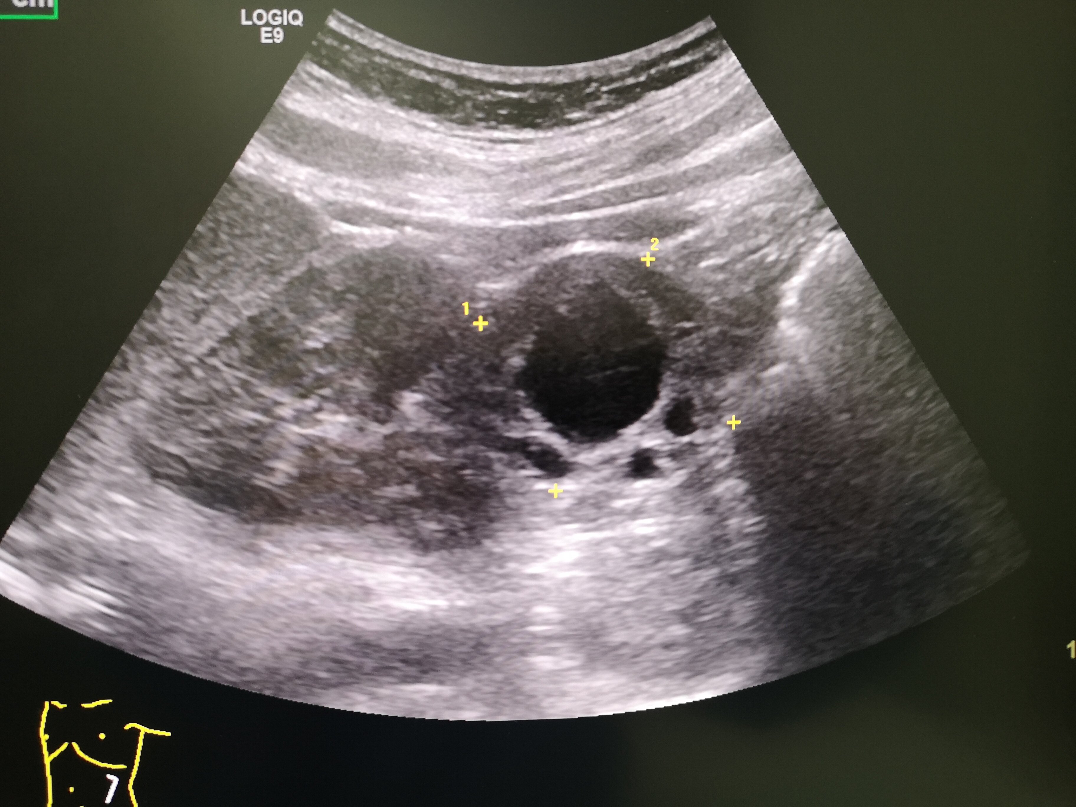 肾肿瘤超声声像图图片