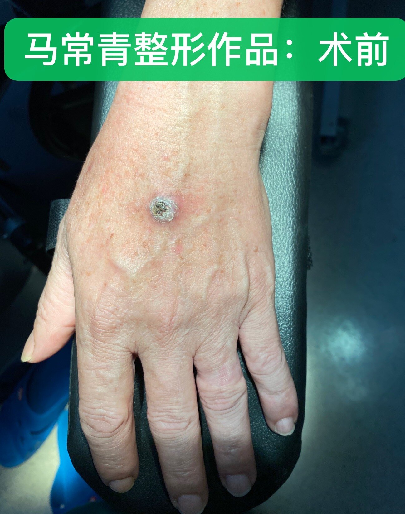 莫把皮肤小肿物不当回事 可能就是皮肤癌 皮肤癌 皮肤癌 莫把皮肤小肿物不当回事 可能就是皮肤癌 皮肤癌 皮肤癌