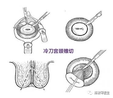 宫颈锥切手术过程图图片