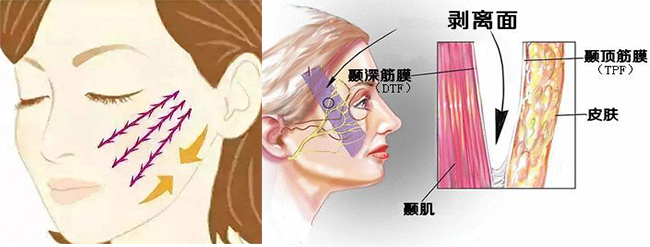 科普拉皮手術跟線雕的區別有哪些