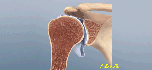 明原因肩痛的统称,较为准确的命名应该是"冻结肩"或"粘连性关节囊炎"