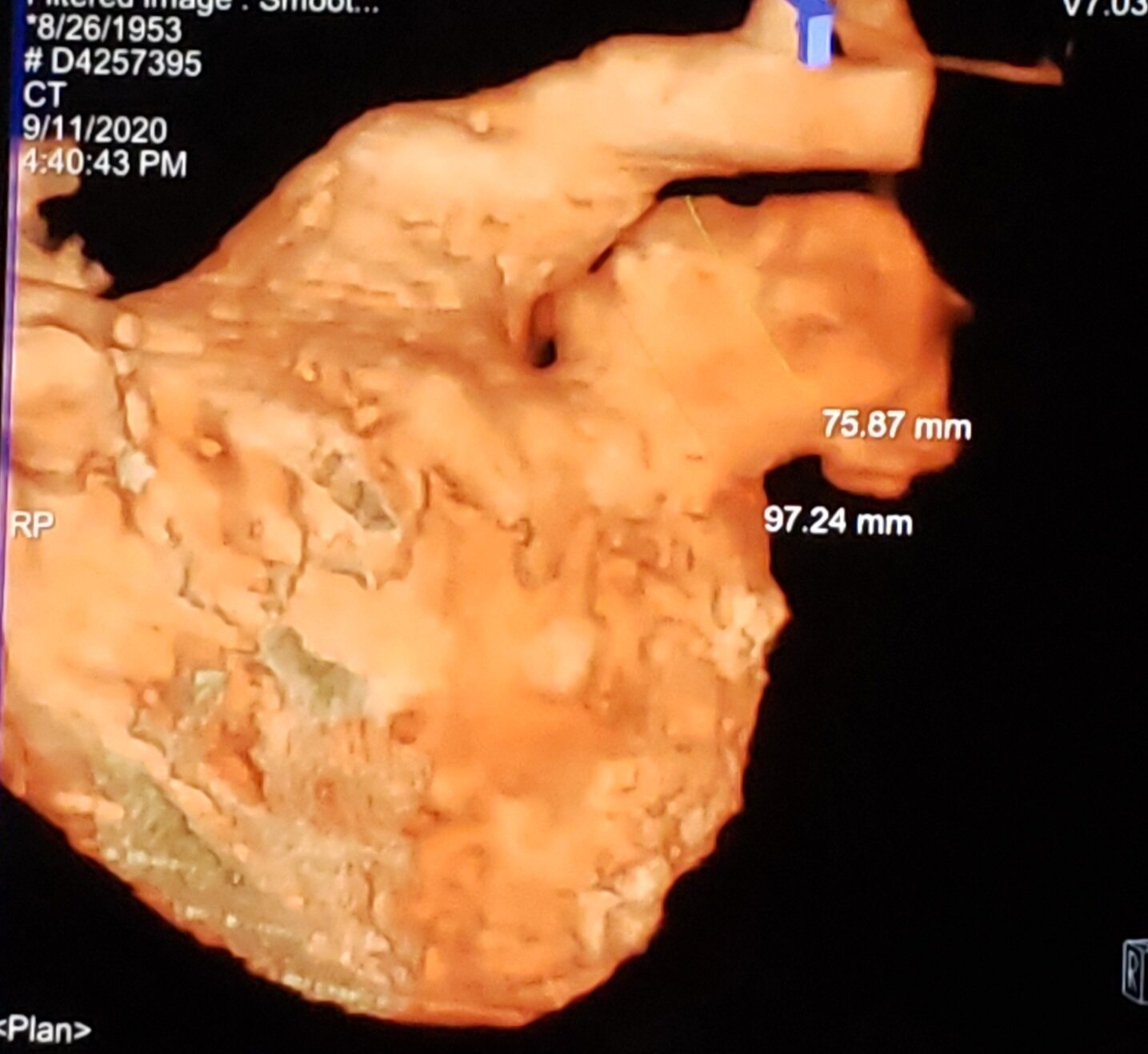左心耳是什么样子,有什么功能? - 好大夫在线