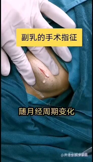 副乳手术切口图片