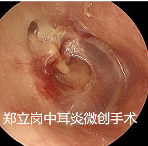 鬆弛部內陷袋伴鼓膜穿孔耳內鏡手術可解決