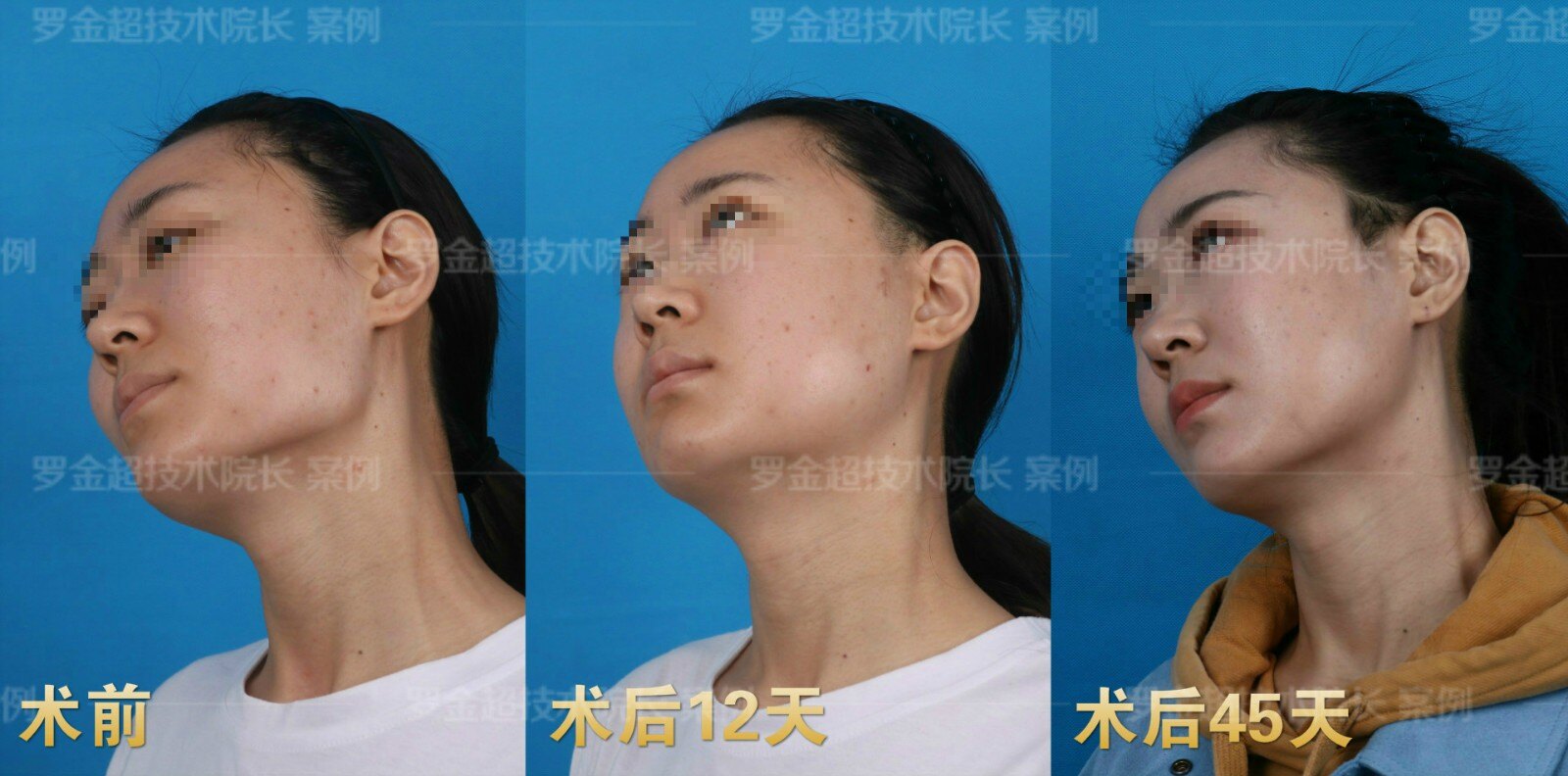 【案例分享】颧骨颧弓 下颌角手术后45天_下颌整形_下颌整形治疗介绍