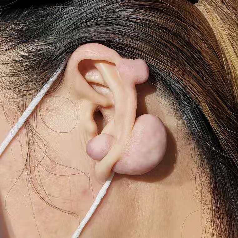 瘢痕疙瘩异常肥厚,有些患者耳垂部位的瘢痕疙瘩可以长到核桃大小;另外