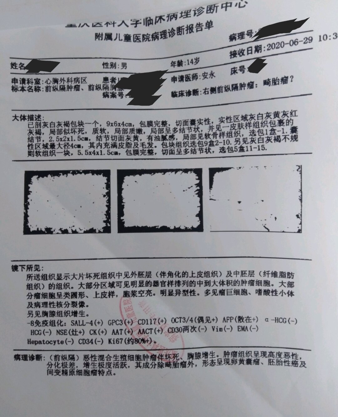 劉懿博士說肺癌(一九二六)前縱隔巨大惡性腫瘤術後要放療嗎